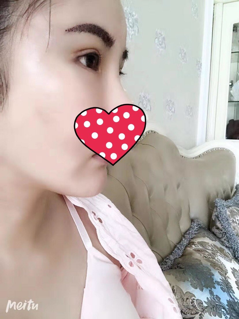 北京东方百合医疗美容门诊部眼部修复怎么样_恢复过程_效果如何_氧气4