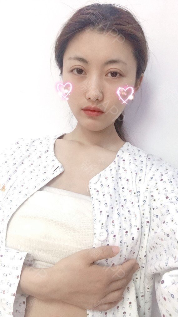 青岛假体隆胸好不好_效果图_氧气7l9u3假体隆胸术后第7天_新氧美容