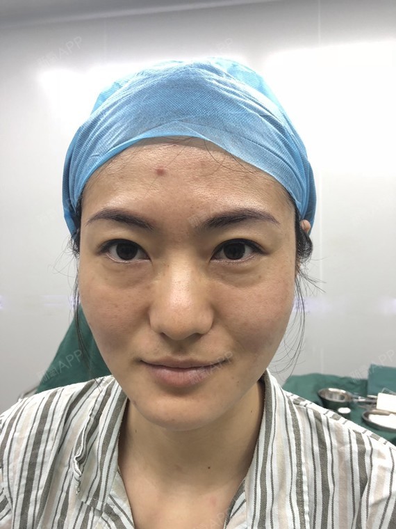 鹰勾鼻,鼻头又大又长,最主要的是鼻头还有点往下垂,导致感觉整个鼻子