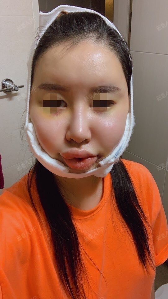 手术第六天,可以慢慢张嘴了,而且嘴唇的肿胀液慢慢消