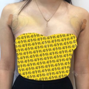 上海陈兵医疗美容 吸脂瘦手臂怎么样_恢复过程_效果如何_氧气6zugg