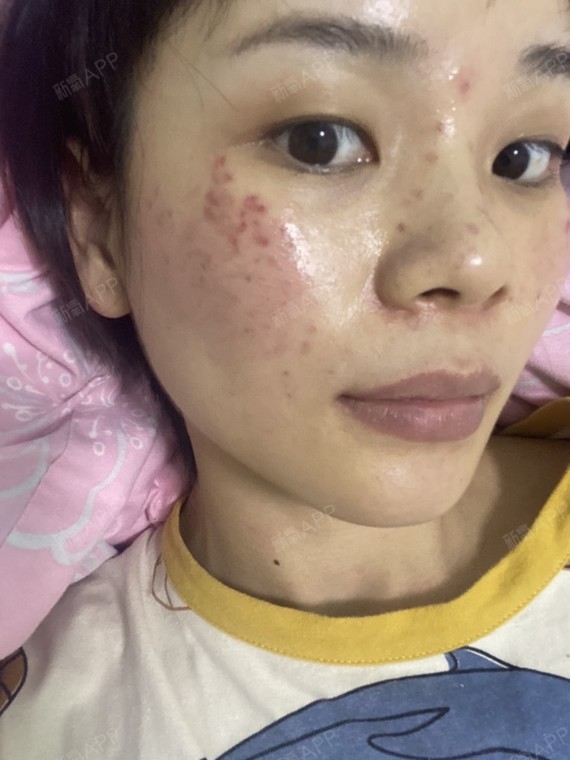 超皮秒第一天,医生表示是褐青色斑,可以去掉.