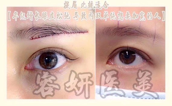 眼部年轻化提眉术,张娟娟医生缝合技术超级好,干干净净术后不