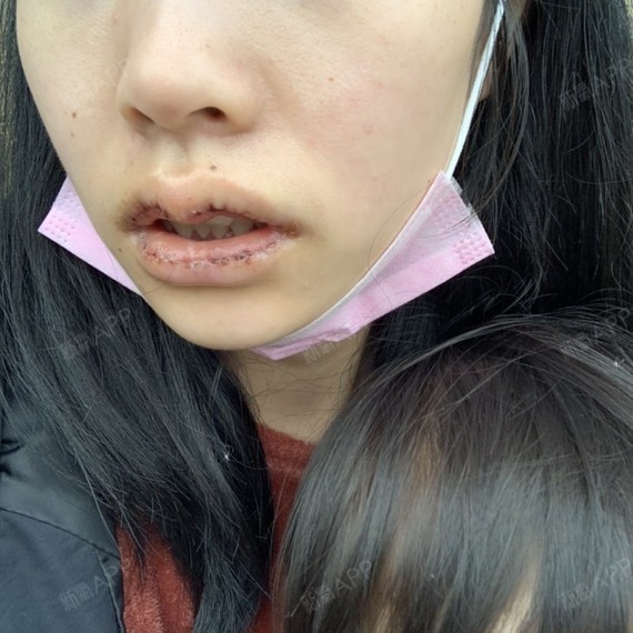 贵阳m唇手术好不好_效果图_氧气dhpuum唇手术术后第7天_新氧美容整形