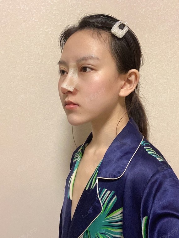 耳软骨复合隆鼻好不好_效果图_热心网友终极进化版耳软骨复合隆鼻术后
