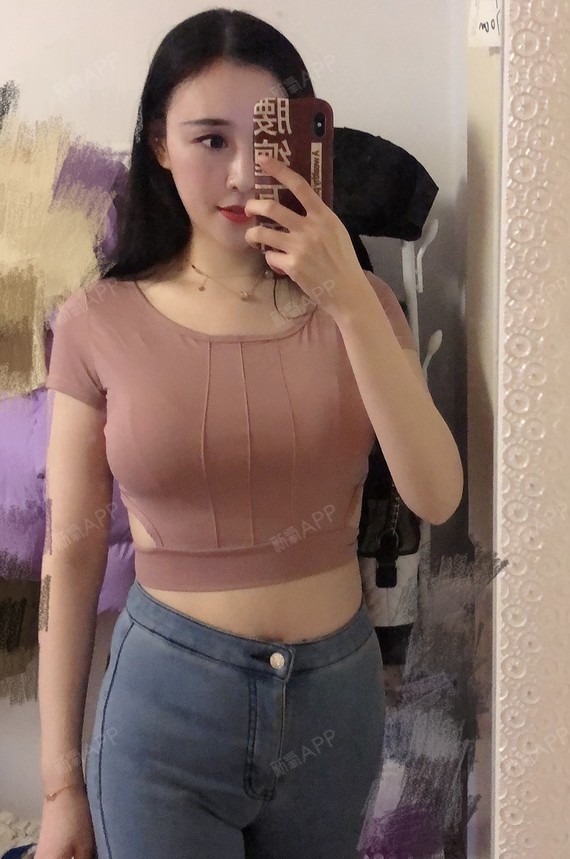 南京假体隆胸好不好_效果图_我的小娟娟假体隆胸术后第82天_新氧美容