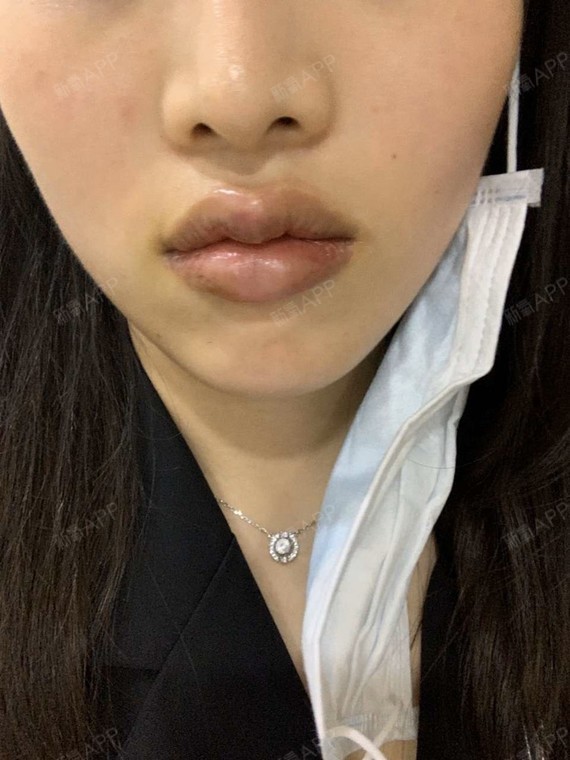 m唇手术项目术后第11天