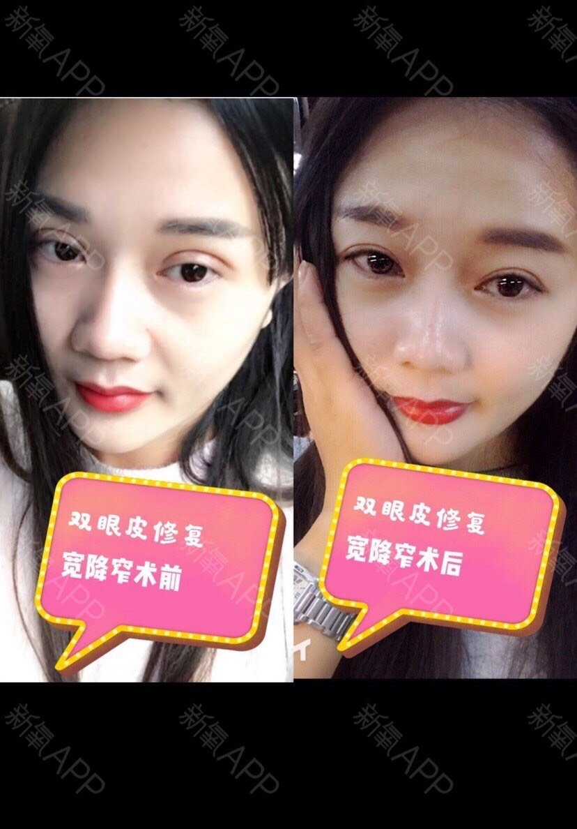 北京睐美安医疗美容诊所 眼部修复怎么样_恢复过程_效果如何_余额不足