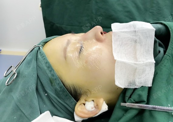 这次做鼻部多项的手术顺便把连鼻基底也改善一下下,因为_圈子-新氧