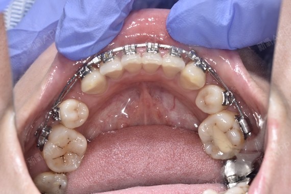 北京自锁托槽矫正好不好_效果图_氧气effez自锁托槽矫正术后第365天