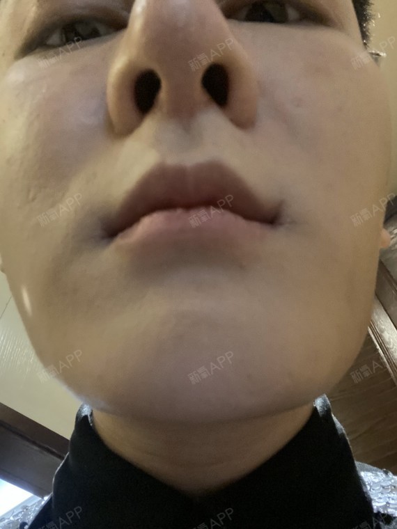 鼻孔撑的好大 鼻头都变圆了