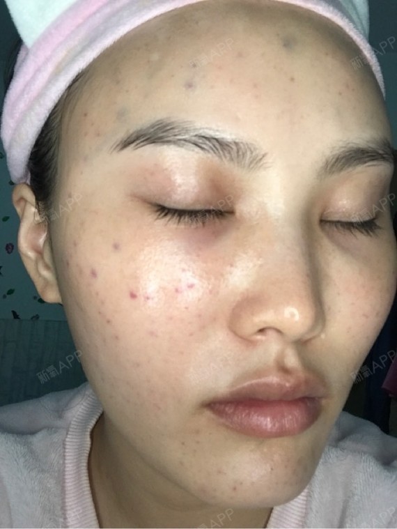 做水光针的第二天晚上,脸上依旧淤青和针孔,白天在医_圈子-新氧美容