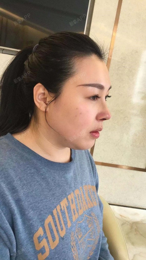 成都假体垫鼻基底好不好_效果图_遇到lena假体垫鼻基底术后第3天_新氧