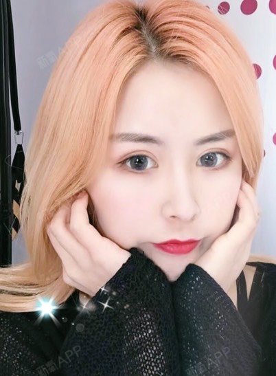 我做的是自然款的双眼皮,宽度是6.5毫米,我觉得刚_圈子-新氧美容整形