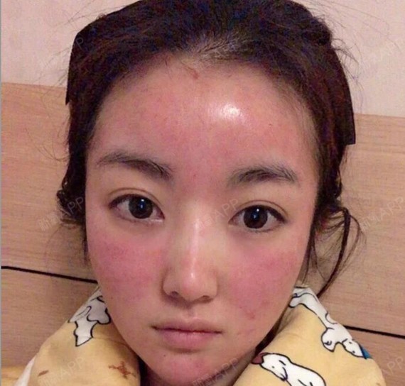 看我的脸就知道了,打完这个丝丽动能素之后满脸通红,_圈子-新氧美容
