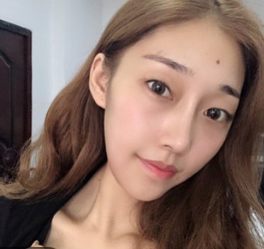 西安尤美醫療美容眼部綜合怎麼樣_恢復過程_效果如何_氧氣kv9da整形