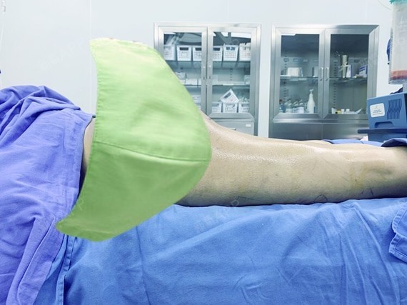 吸脂瘦大腿