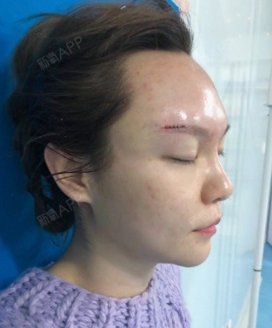 做假体垫眉弓是局部麻醉的,我觉得打麻药的疼痛感也还_圈子-新氧美容