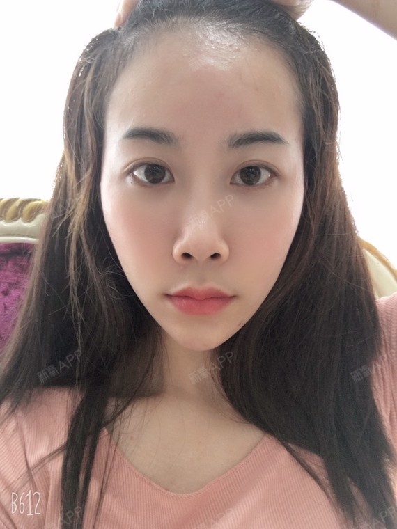 玻尿酸丰额头