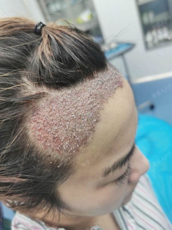 种植发际线的第一天有点新鲜刚做完就来分享一下大家看得到我的脑门是