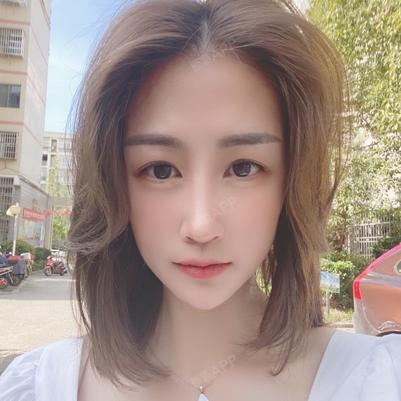 超体隆鼻好不好_效果图_氧气0791超体隆鼻术后第86天_新氧美容整形