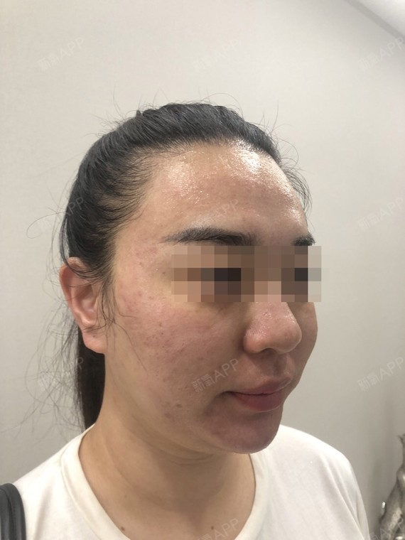 伊肤泉微针好不好_效果图_莹莹li伊肤泉微针术后第0天_新氧美容整形