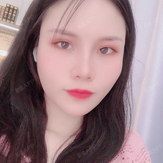 广西南宁眼部多项好不好_效果图_小美子君眼部多项术后第457天_新氧