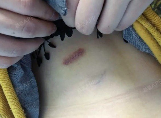 这是肋软骨那里的伤口,伤口现在是这样子的,这是第十_圈子-新氧美容