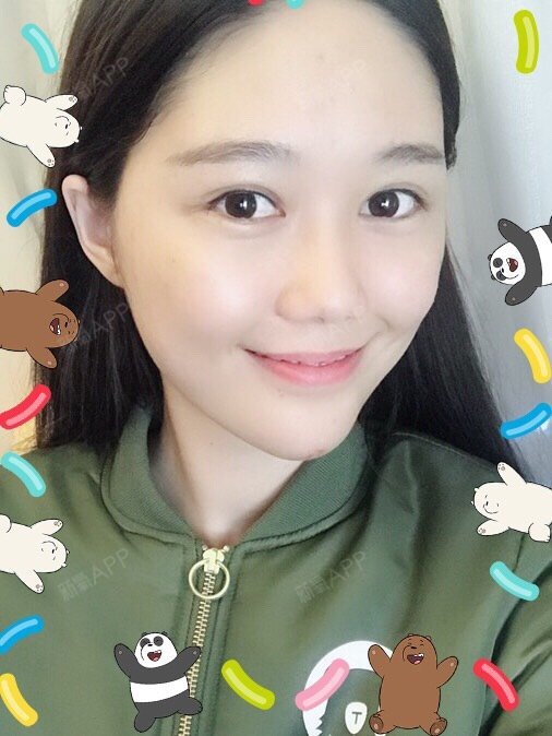 93看看我的纯天然妈生款双眼皮吧～～恢复的还真挺快的_圈子-新氧