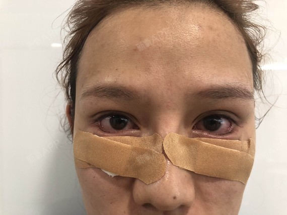 想要把眼睛变得大一些,所以就来做了眼睑下至