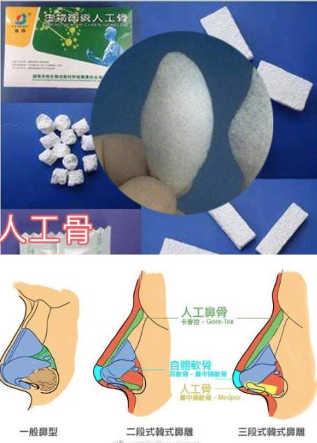 异体骨和人工骨的区别:异体骨是别人的肋软骨,人工骨_圈子-新氧美容