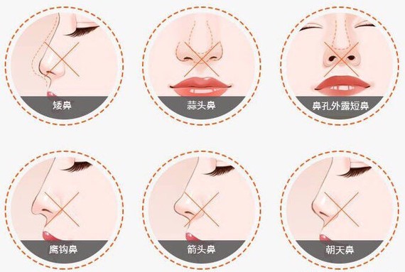 有人鼻尖低,有人鼻背有驼峰;有的人鼻孔外露,有的人鼻子像鹰嘴