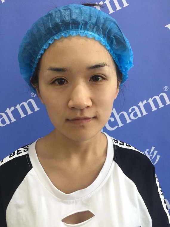 [郑州华山医院]做假体隆鼻手术恢复时间需要很