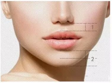 科普一下面部吸土机:人中缩短术