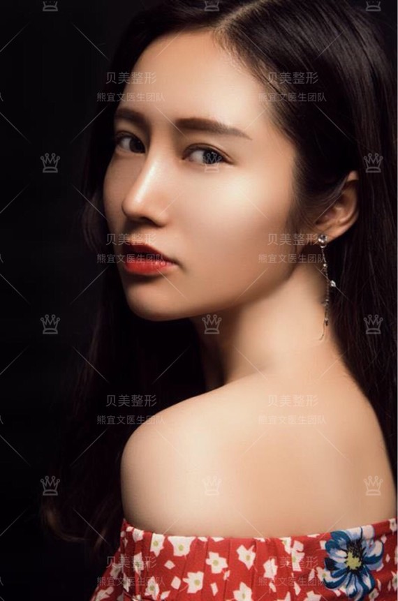 美女是个服装模特,术前基础还可以,主要问题:山根鼻梁高度不够,鼻头钝