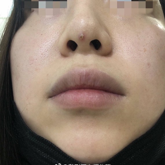 【线雕隆鼻顶破了鼻尖怎么办!