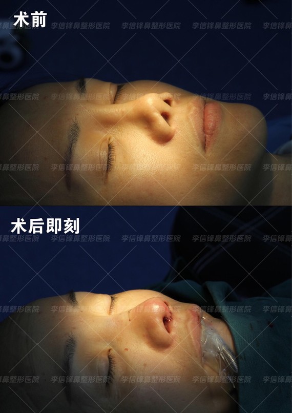 【手术方案】全肋修复,鼻尖延长,鼻翼缘鼻孔调整,鼻中隔重建,筋膜加厚