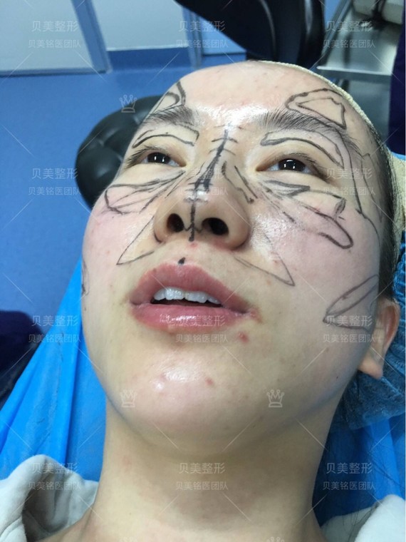 全脸脂肪填充 耳软骨鼻部多项术前画线设计