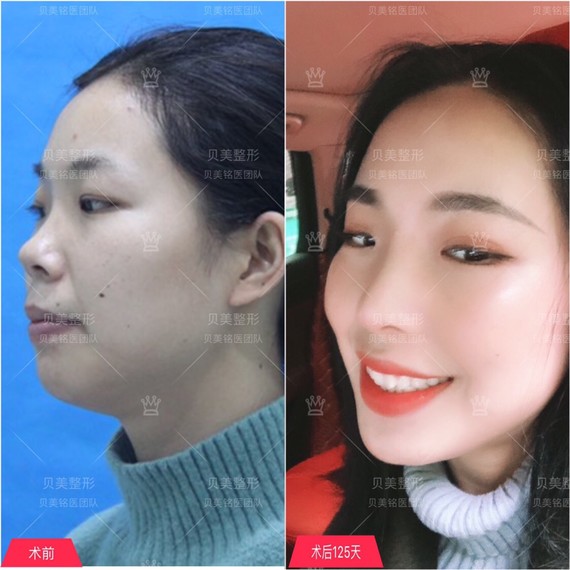 鼻小柱过短是有隆鼻需求顾客中最常见的鼻部问题,过短_圈子-新氧美容