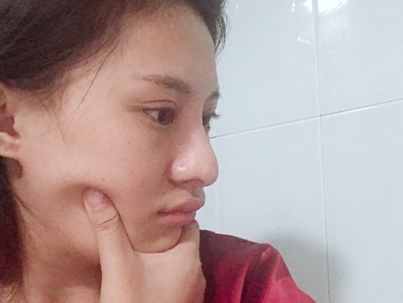 肋骨鼻三个半月了鼻头还是这样家里人说像鹰钩鼻上个月打了增生针没