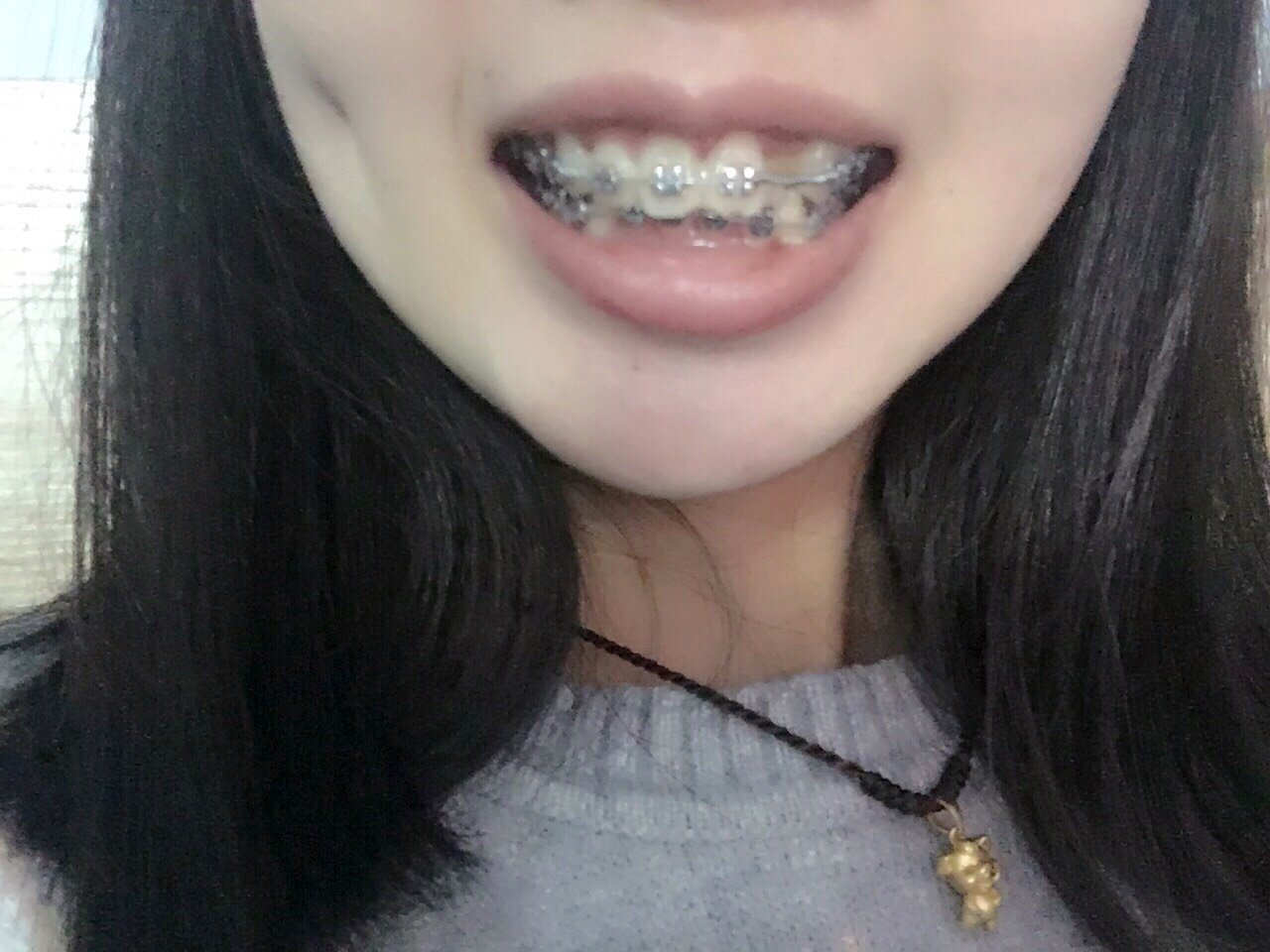 标准的八颗牙的微笑 下牙套那刻人生都亮堂了