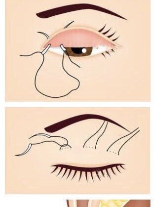 埋线双眼皮之你问我答