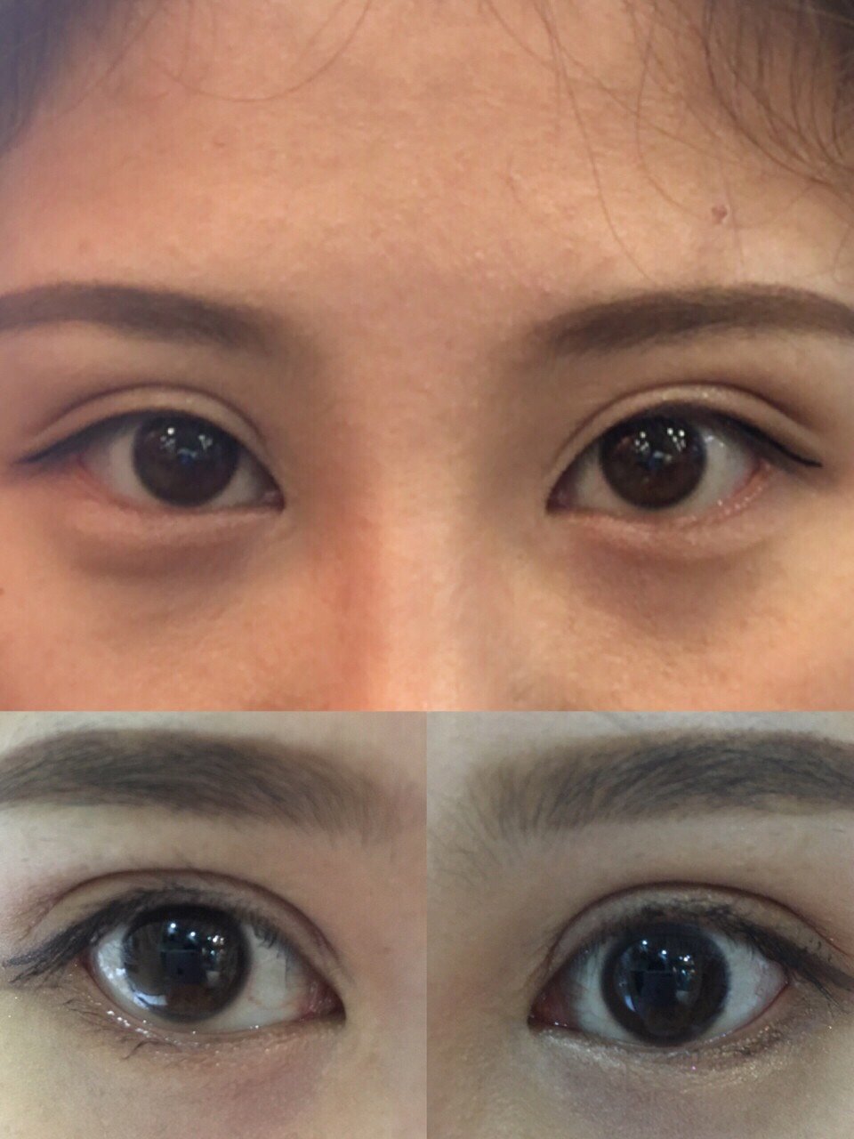 双眼皮手术|画面太美,胆小慎入!