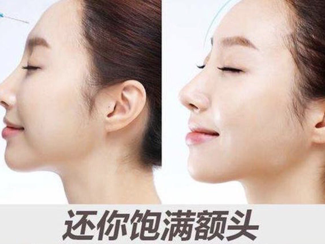 目前额头填充常见方法都有哪些?