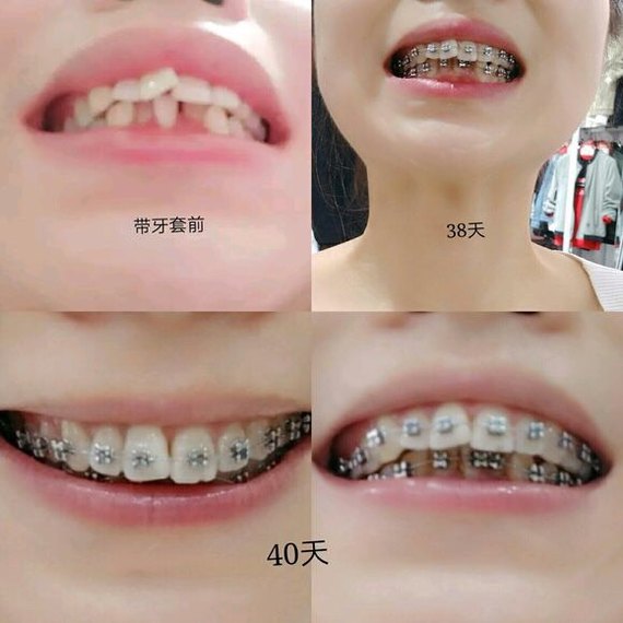 说下我的"烂"牙齿:  上牙歪,下牙有两颗牙重合了,吃东西老