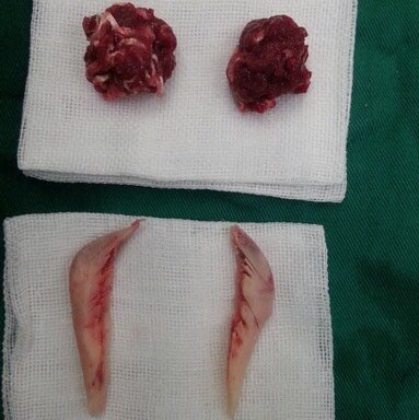 下颌角削骨截骨磨骨都有什么区别6015颧骨内推是磨骨还_圈子-新氧