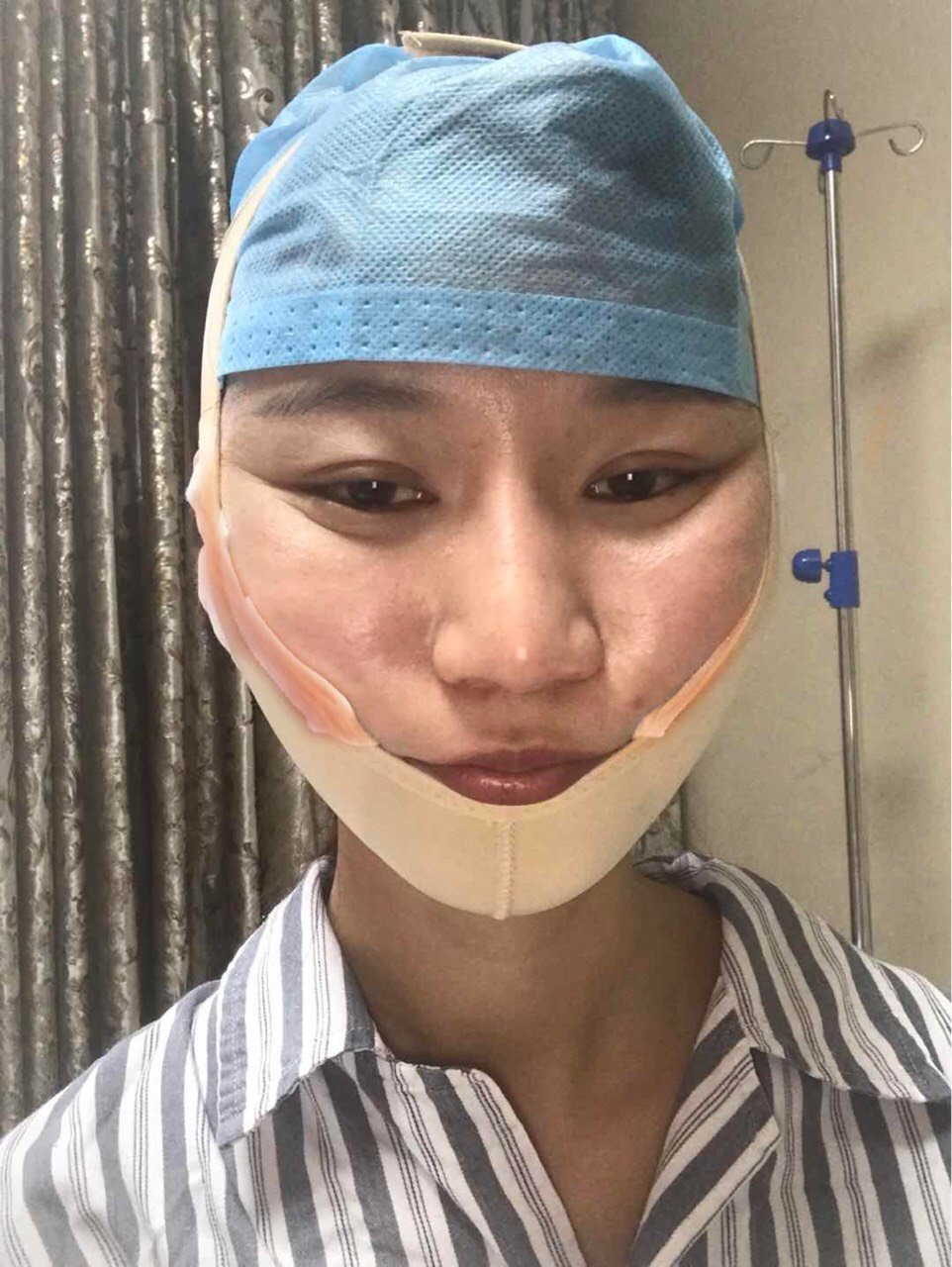 下颌角削骨截骨磨骨都有什么区别6015颧骨内推是