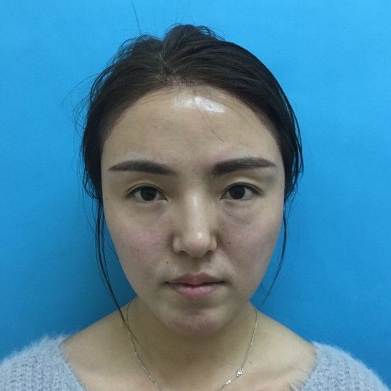 做完之后眼睛_圈子-新氧美容整形