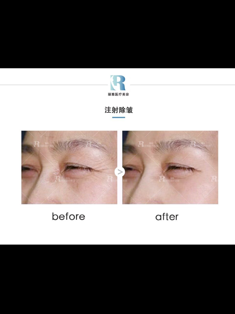 注射除皱达到的效果1,高效保湿注射除皱能够吸收和保_圈子-新氧美容