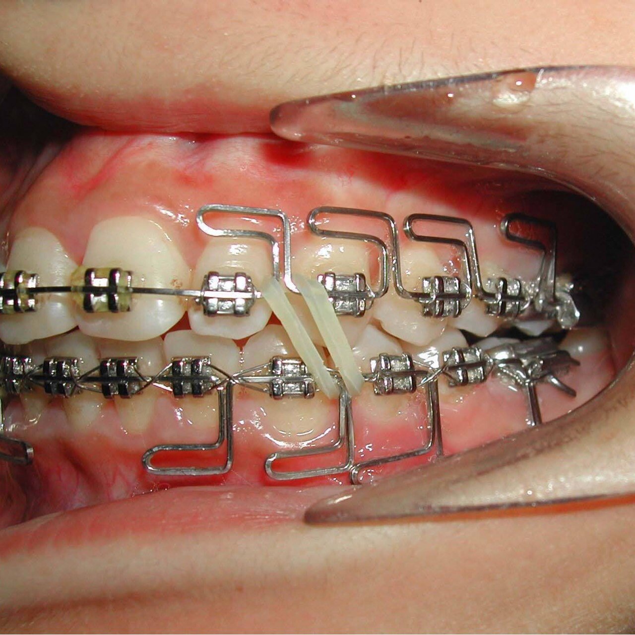 矫正改善咬合关系